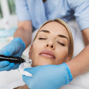 microneedling