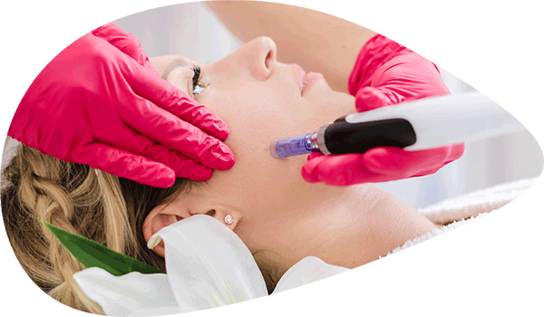 microneedling