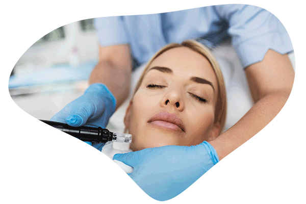 microneedling